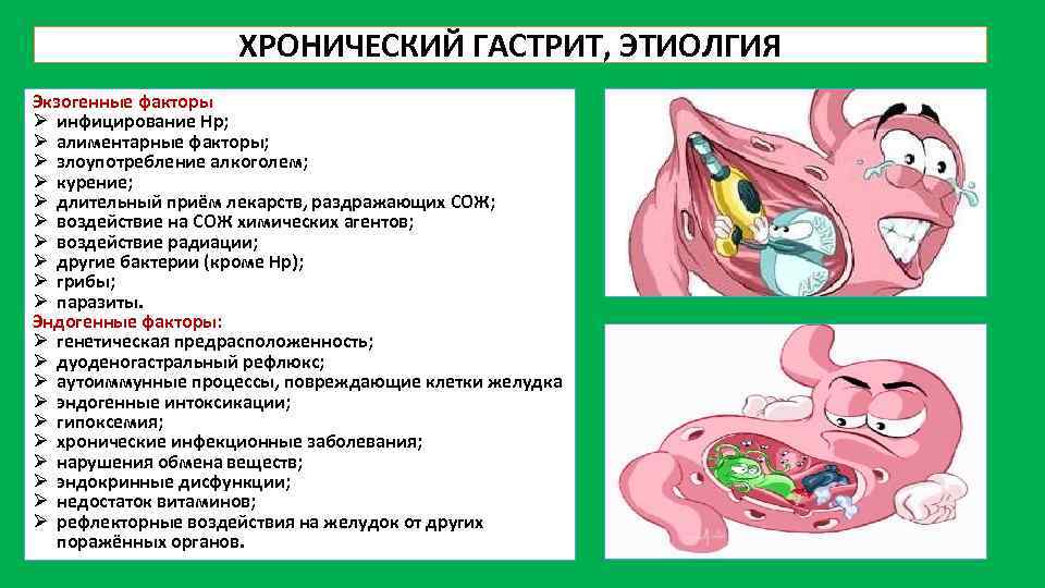 ХРОНИЧЕСКИЙ ГАСТРИТ, ЭТИОЛГИЯ Экзогенные факторы Ø инфицирование Нр; Ø алиментарные факторы; Ø злоупотребление алкоголем;