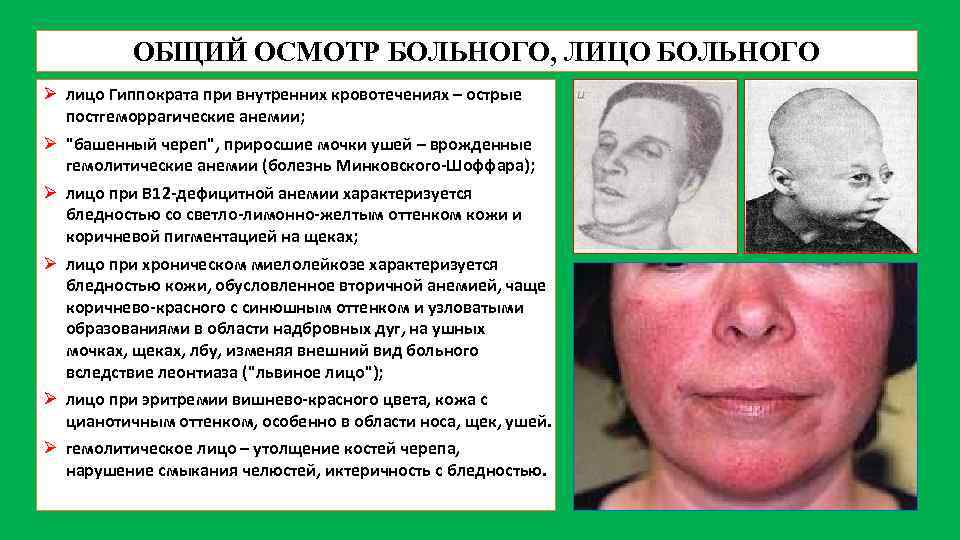 ОБЩИЙ ОСМОТР БОЛЬНОГО, ЛИЦО БОЛЬНОГО Ø лицо Гиппократа при внутренних кровотечениях – острые постгеморрагические
