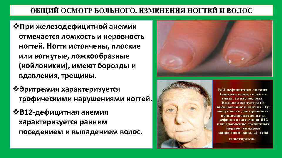 ОБЩИЙ ОСМОТР БОЛЬНОГО, ИЗМЕНЕНИЯ НОГТЕЙ И ВОЛОС v. При железодефицитной анемии отмечается ломкость и