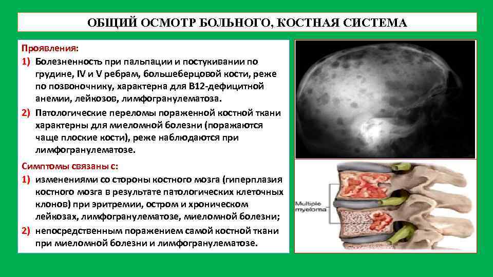 ОБЩИЙ ОСМОТР БОЛЬНОГО, КОСТНАЯ СИСТЕМА Проявления: 1) Болезненность при пальпации и постукивании по грудине,