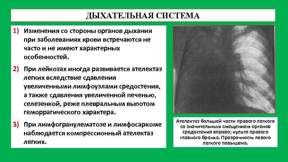 ДЫХАТЕЛЬНАЯ СИСТЕМА 1) Изменения со стороны органов дыхания при заболеваниях крови встречаются не часто