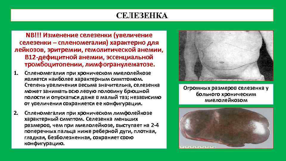 СЕЛЕЗЕНКА NB!!! Изменение селезенки (увеличение селезенки – спленомегалия) характерно для лейкозов, эритремии, гемолитической анемии,