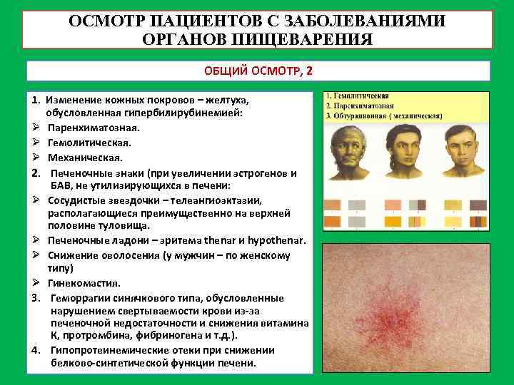 ОСМОТР ПАЦИЕНТОВ С ЗАБОЛЕВАНИЯМИ ОРГАНОВ ПИЩЕВАРЕНИЯ ОБЩИЙ ОСМОТР, 2 1. Изменение кожных покровов –