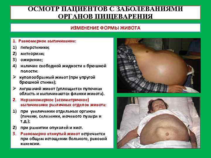 ОСМОТР ПАЦИЕНТОВ С ЗАБОЛЕВАНИЯМИ ОРГАНОВ ПИЩЕВАРЕНИЯ ИЗМЕНЕНИЕ ФОРМЫ ЖИВОТА 1. 1) 2) 3) 4)