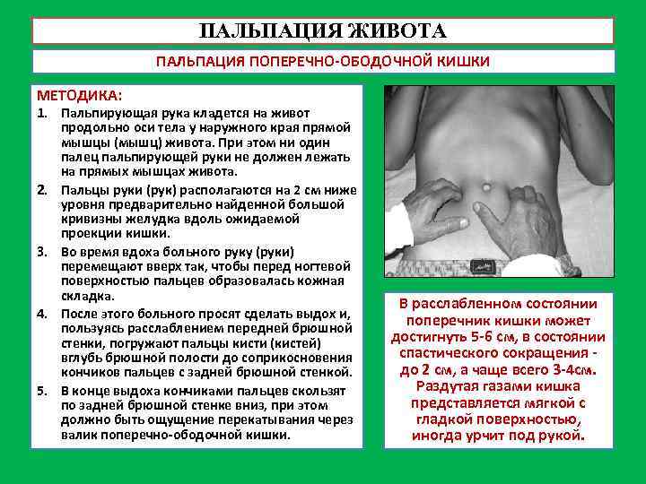 ПАЛЬПАЦИЯ ЖИВОТА ПАЛЬПАЦИЯ ПОПЕРЕЧНО-ОБОДОЧНОЙ КИШКИ МЕТОДИКА: 1. Пальпирующая рука кладется на живот продольно оси