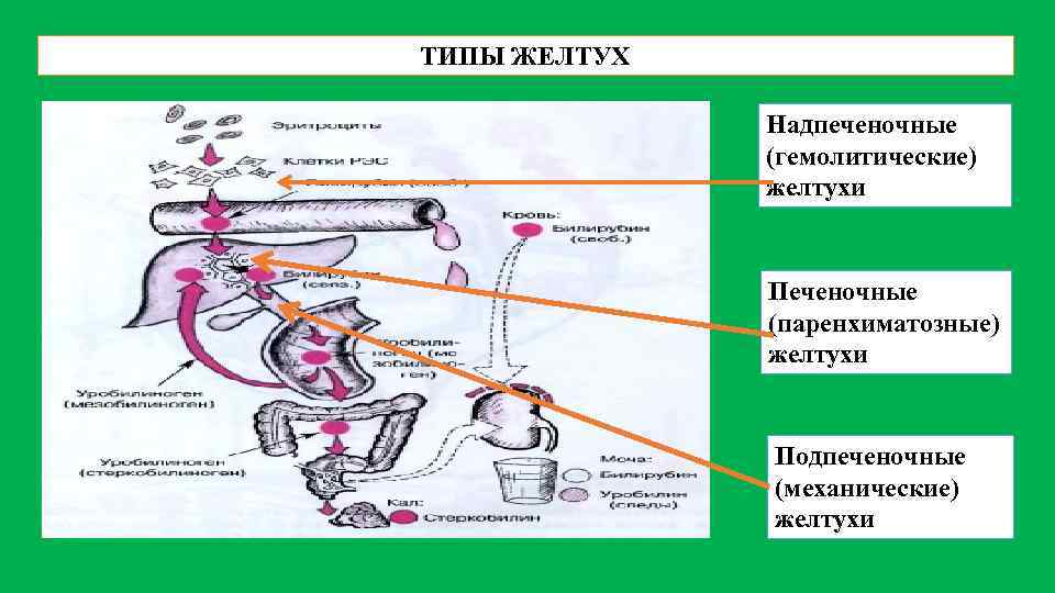 Паренхиматозная желтуха схема