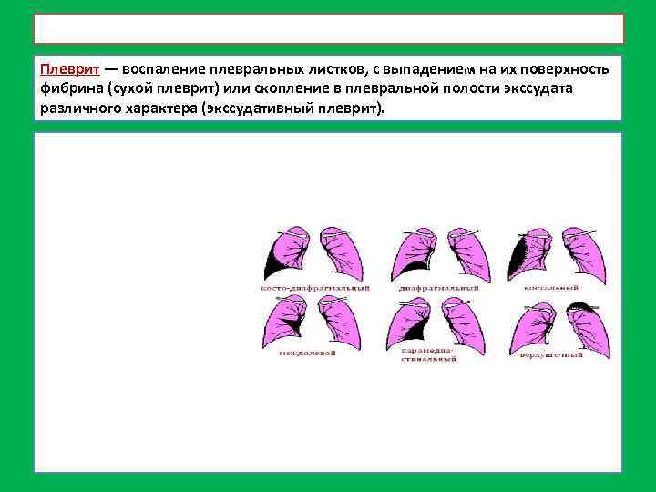 Плеврит карта вызова смп