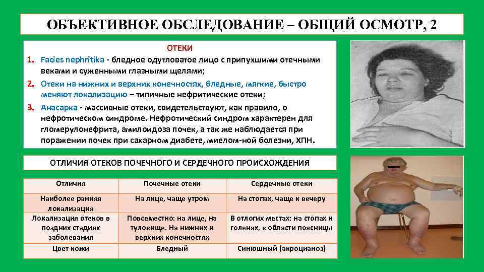 ОБЪЕКТИВНОЕ ОБСЛЕДОВАНИЕ – ОБЩИЙ ОСМОТР, 2 ОТЕКИ 1. Facies nephritikа - бледное одутловатое лицо