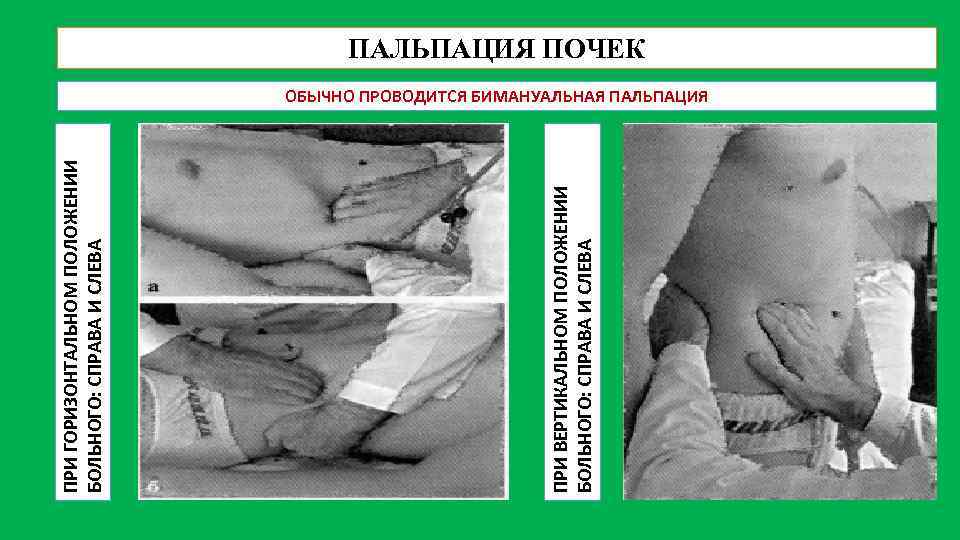 ПРИ ВЕРТИКАЛЬНОМ ПОЛОЖЕНИИ БОЛЬНОГО: СПРАВА И СЛЕВА ПРИ ГОРИЗОНТАЛЬНОМ ПОЛОЖЕНИИ БОЛЬНОГО: СПРАВА И СЛЕВА