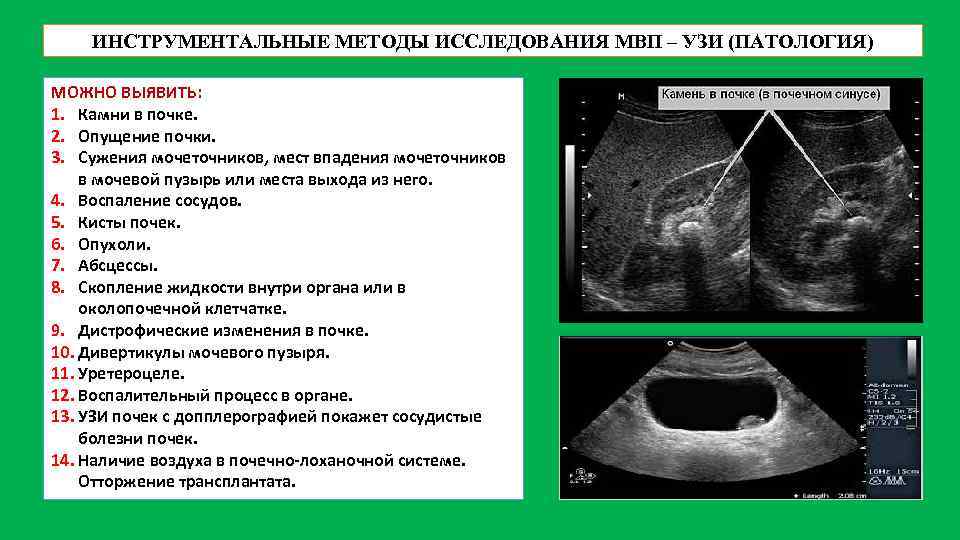 ИНСТРУМЕНТАЛЬНЫЕ МЕТОДЫ ИССЛЕДОВАНИЯ МВП – УЗИ (ПАТОЛОГИЯ) МОЖНО ВЫЯВИТЬ: 1. Камни в почке. 2.