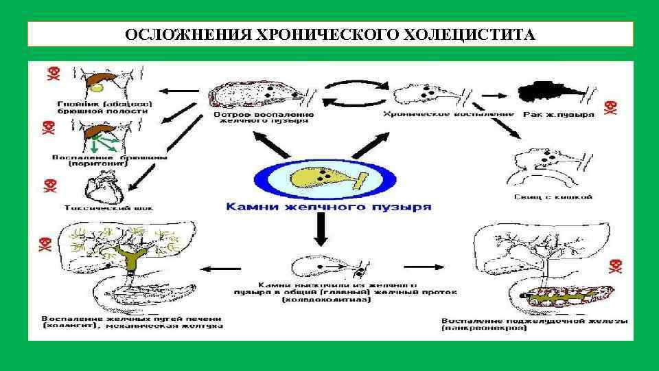 Калькулезный холецистит патогенез. Осложнения холецистита. Последствия хронического холецистита. Патогенез хронического холецистита. Хронического холецистит исходы и осложнения.