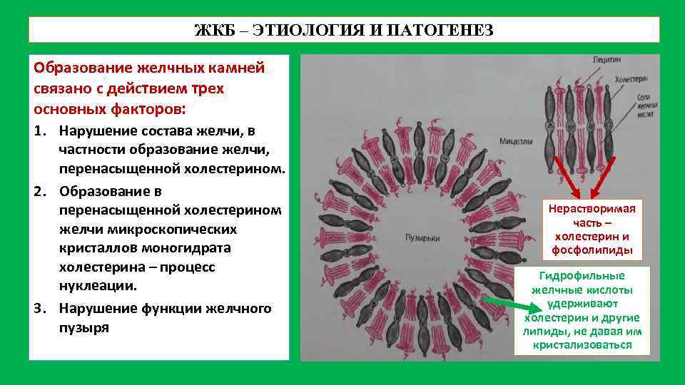 ЖКБ – ЭТИОЛОГИЯ И ПАТОГЕНЕЗ Образование желчных камней связано с действием трех основных факторов: