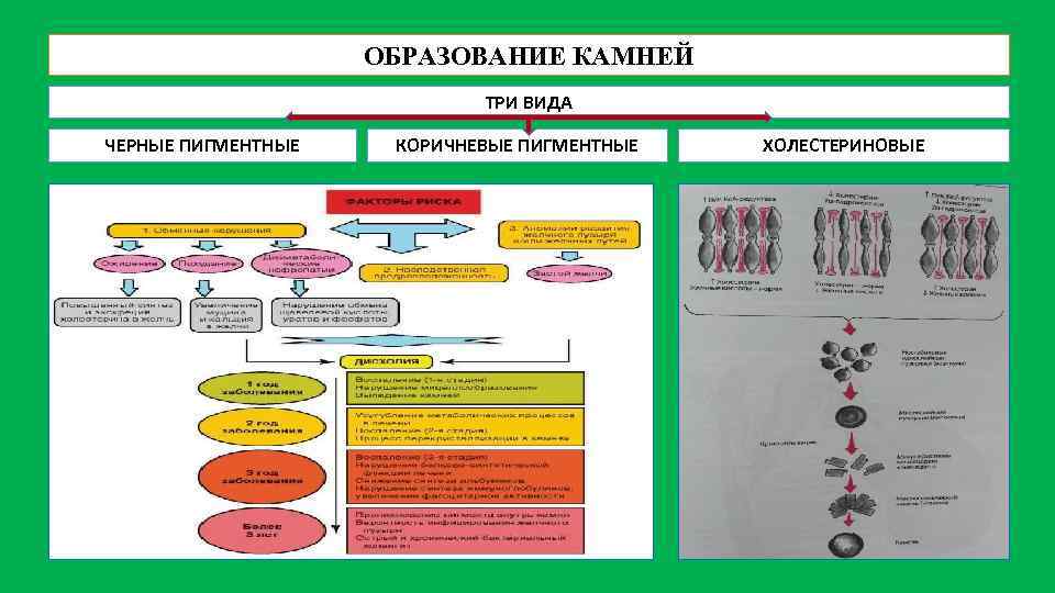 ОБРАЗОВАНИЕ КАМНЕЙ ТРИ ВИДА ЧЕРНЫЕ ПИГМЕНТНЫЕ КОРИЧНЕВЫЕ ПИГМЕНТНЫЕ ХОЛЕСТЕРИНОВЫЕ 