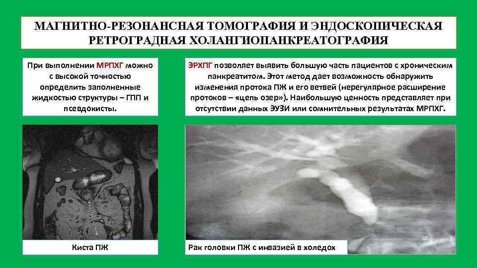 МАГНИТНО-РЕЗОНАНСНАЯ ТОМОГРАФИЯ И ЭНДОСКОПИЧЕСКАЯ РЕТРОГРАДНАЯ ХОЛАНГИОПАНКРЕАТОГРАФИЯ При выполнении МРПХГ можно с высокой точностью определить