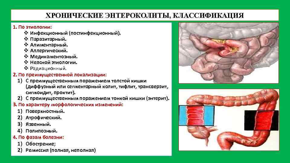 ХРОНИЧЕСКИЕ ЭНТЕРОКОЛИТЫ, КЛАССИФИКАЦИЯ 1. По этиологии: v Инфекционный (постинфекционный). v Паразитарный. v Алиментарный. v