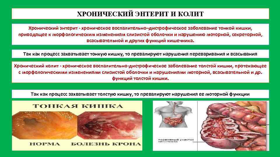 ХРОНИЧЕСКИЙ ЭНТЕРИТ И КОЛИТ Хронический энтерит хроническое воспалительно–дистрофическое заболевание тонкой кишки, приводящее к морфологическим