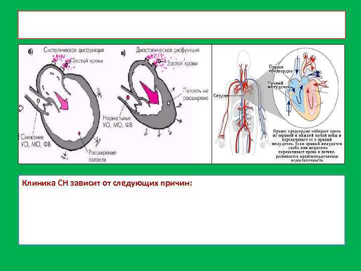 Клиника СН зависит от следующих причин: 