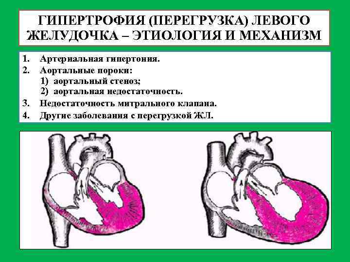 ГИПЕРТРОФИЯ (ПЕРЕГРУЗКА) ЛЕВОГО ЖЕЛУДОЧКА – ЭТИОЛОГИЯ И МЕХАНИЗМ 1. 2. 3. 4. Артериальная гипертония.