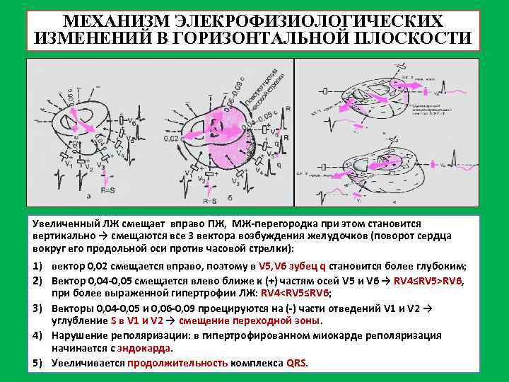 МЕХАНИЗМ ЭЛЕКРОФИЗИОЛОГИЧЕСКИХ ИЗМЕНЕНИЙ В ГОРИЗОНТАЛЬНОЙ ПЛОСКОСТИ Увеличенный ЛЖ смещает вправо ПЖ, МЖ-перегородка при этом