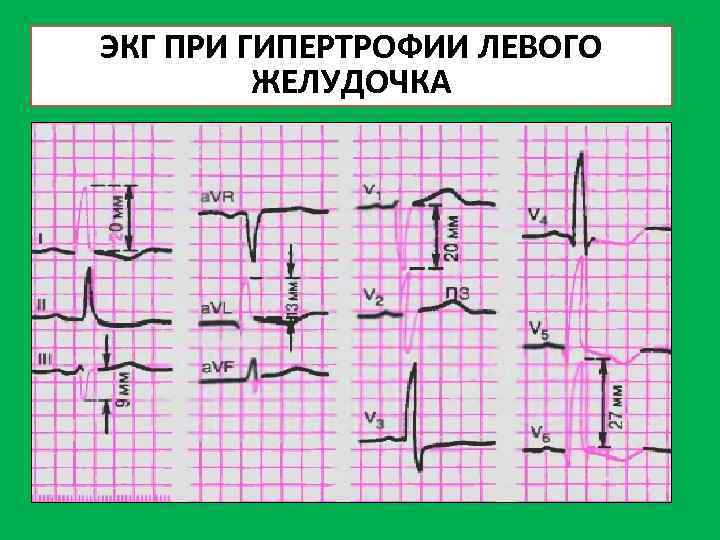 ЭКГ ПРИ ГИПЕРТРОФИИ ЛЕВОГО ЖЕЛУДОЧКА 