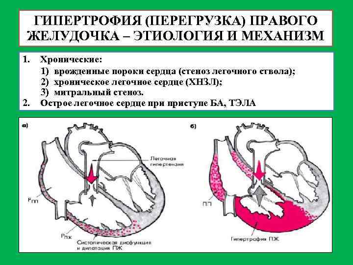 ГИПЕРТРОФИЯ (ПЕРЕГРУЗКА) ПРАВОГО ЖЕЛУДОЧКА – ЭТИОЛОГИЯ И МЕХАНИЗМ 1. 2. Хронические: 1) врожденные пороки