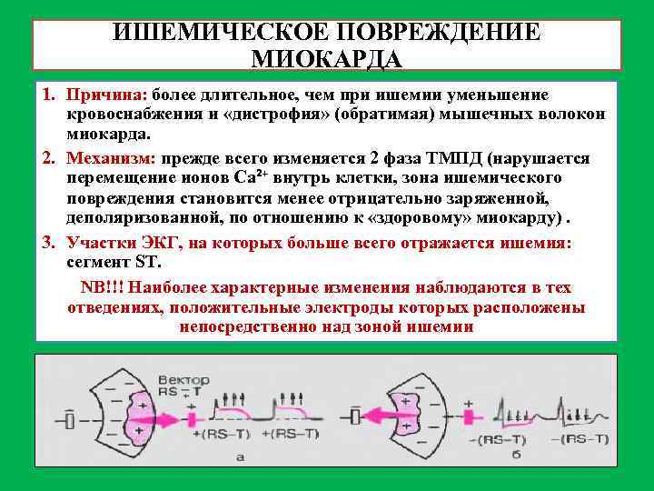 ИШЕМИЧЕСКОЕ ПОВРЕЖДЕНИЕ МИОКАРДА 1. Причина: более длительное, чем при ишемии уменьшение кровоснабжения и «дистрофия»