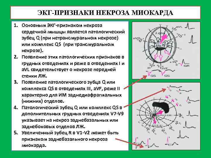 ЭКГ-ПРИЗНАКИ НЕКРОЗА МИОКАРДА 1. Основным ЭКГ-признаком некроза сердечной мышцы является патологический зубец Q (при