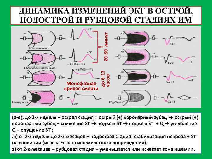 Монофазная кривая смерти до 6 -12 часов 20 -30 минут ДИНАМИКА ИЗМЕНЕНИЙ ЭКГ В