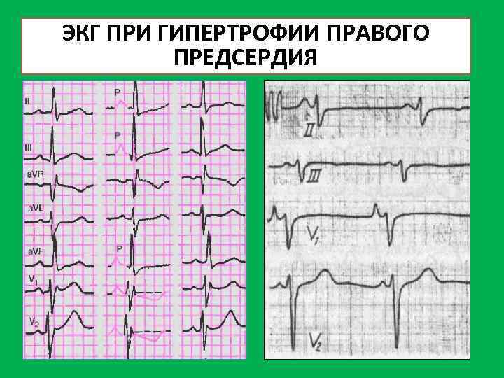 Экг при гиперкалиемии картинки