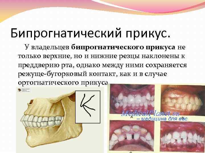 Опистогнатический прикус картинки