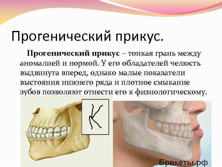 Окклюзия характеризуется. Физиологический прикус прогения. Прогенический прикус кратко. Центральная окклюзия ортогнатический прикус.