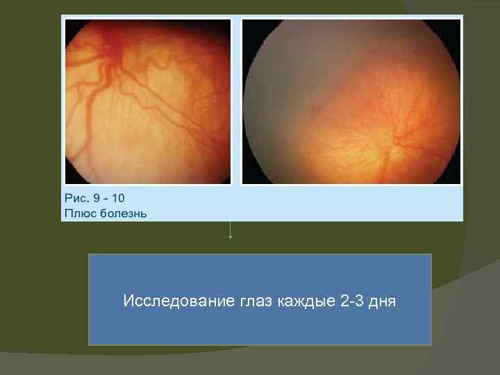  Плюс-болезнь, задняя агрессивная РН Исследование глаз каждые 2 -3 дня 