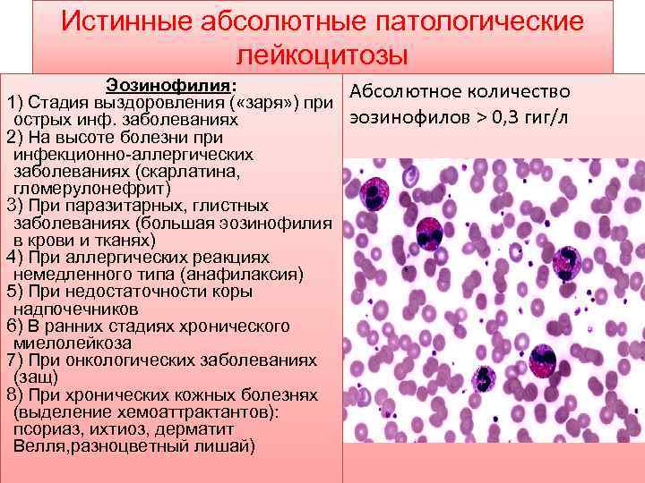 Истинные абсолютные патологические лейкоцитозы Эозинофилия: 1) Стадия выздоровления ( «заря» ) при острых инф.