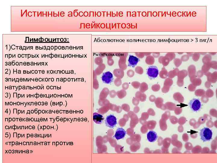 Истинные абсолютные патологические лейкоцитозы Лимфоцитоз: Абсолютное количество лимфоцитов ˃ 3 гиг/л 1)Стадия выздоровления при