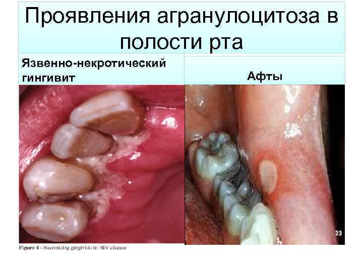 Проявления агранулоцитоза в полости рта Язвенно-некротический гингивит Афты 