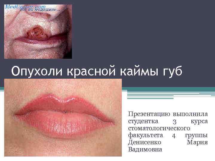 Опухоли красной каймы губ Презентацию выполнила студентка 3 курса стоматологического факультета 4 группы Денисенко
