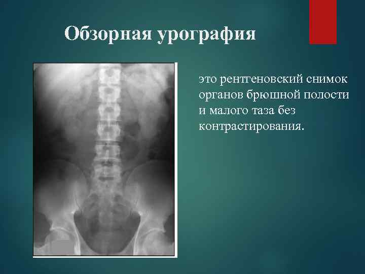 Обзорная урография это рентгеновский снимок органов брюшной полости и малого таза без контрастирования. 