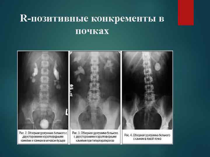 Что такое конкременты. Конкремент мочеточника рентген. Конкремент правой почки. Конкремент левой почки. Конкремент правой почки 3 мм.