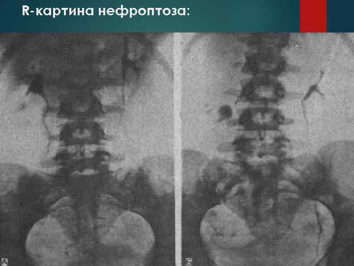 Степени нефроптоза