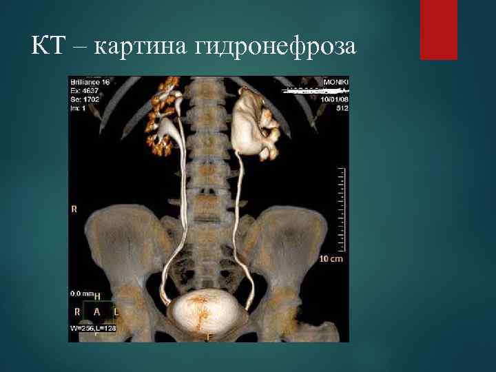 КТ – картина гидронефроза 