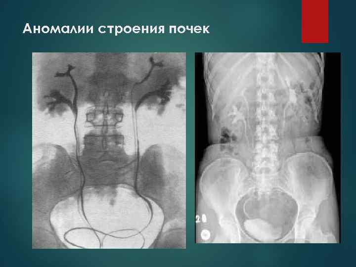 Аномалии строения почек 