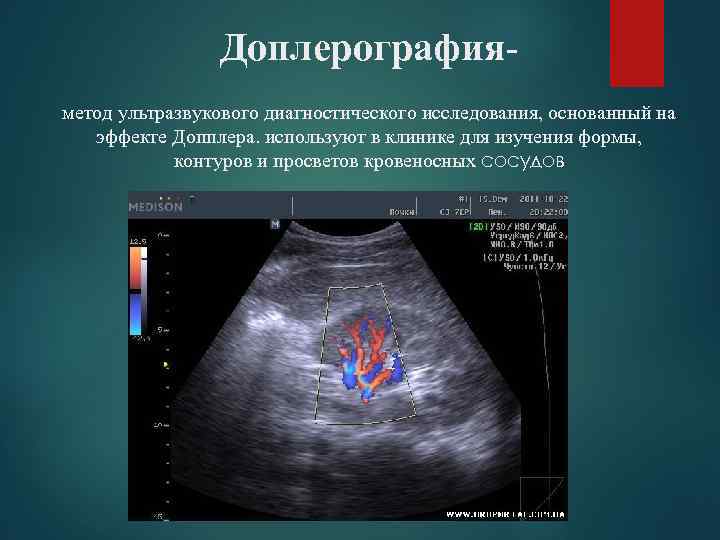 Доплерографияметод ультразвукового диагностического исследования, основанный на эффекте Допплера. используют в клинике для изучения формы,