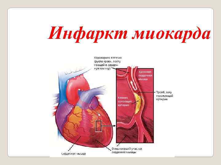 Инфаркт миокарда 