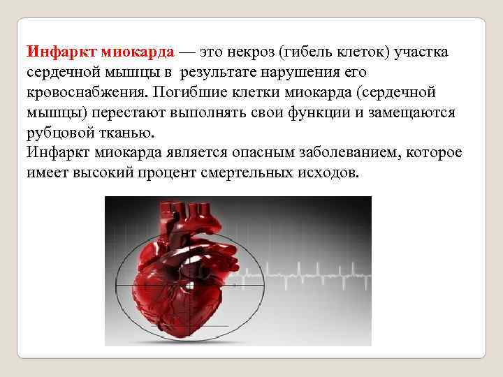 Инфаркт миокарда — это некроз (гибель клеток) участка сердечной мышцы в результате нарушения его