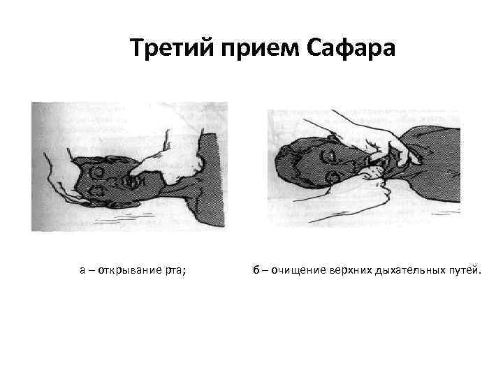 Третий прием Сафара а – открывание рта; б – очищение верхних дыхательных путей. 