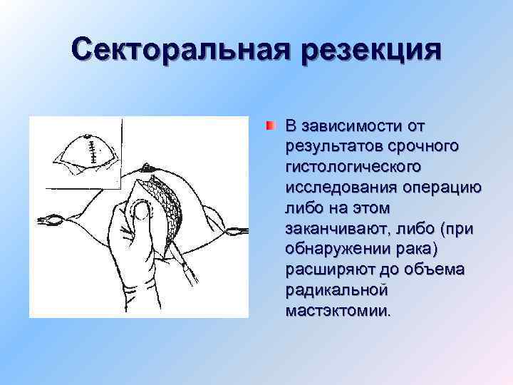 Резекция молочной железы реабилитация