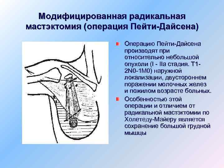 Модифицированная радикальная мастэктомия (операция Пейти-Дайсена) Операцию Пейти-Дайсена производят при относительно небольшой опухоли (I -