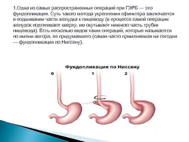 1. Одна из самых распространенных операций при ГЭРБ — это фундопликация. Суть такого метода