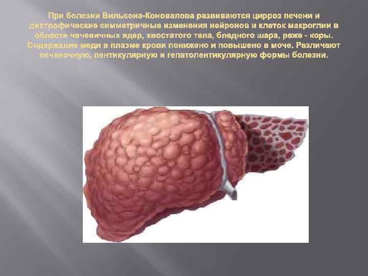 При болезни Вильсона-Коновалова развиваются цирроз печени и дистрофические симметричные изменения нейронов и клеток макроглии