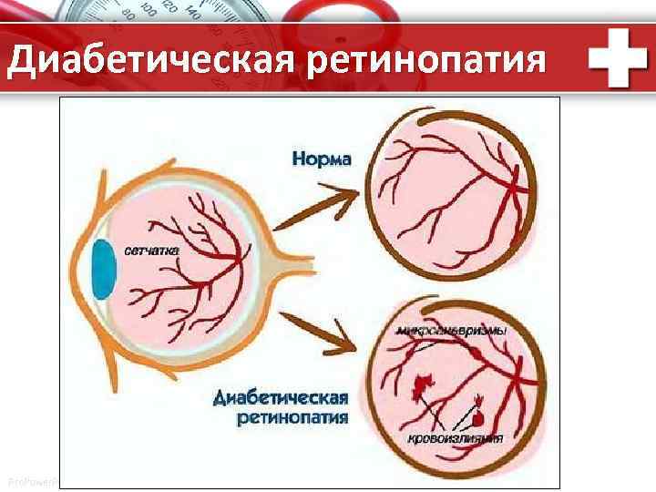 Диабетическая ретинопатия Pro. Power. Point. Ru 